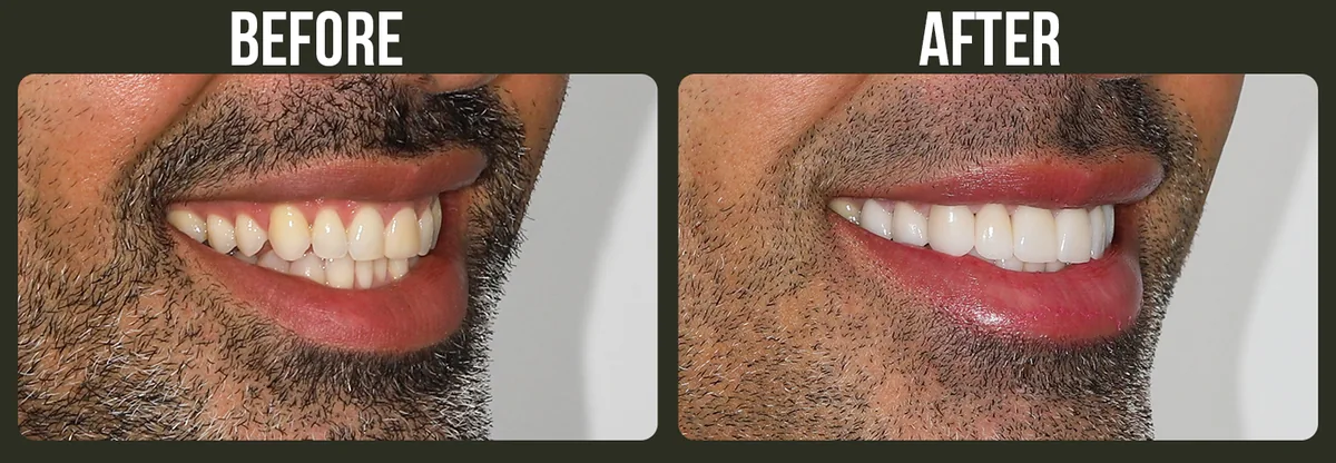 Before and after dental veneers — Horizon Dental patient
