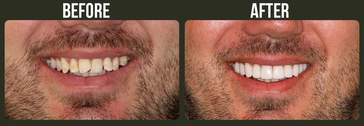 Before and after dental treatment — Horizon Dental patient