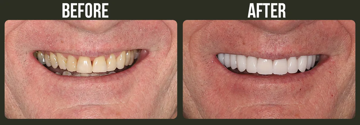 Before and after dental veneers — Horizon Dental patient