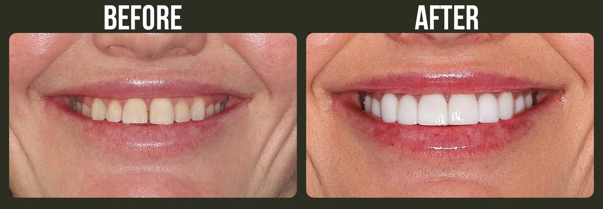 Before and after dental treatment — Horizon Dental patient