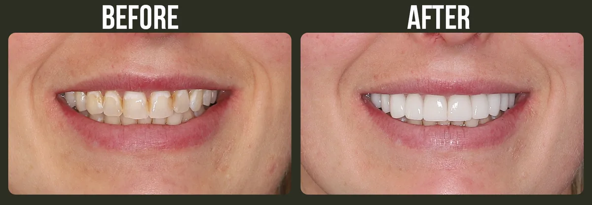 Before and after dental veneers — Horizon Dental patient