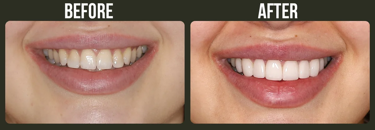 Before and after dental treatment — Horizon Dental patient