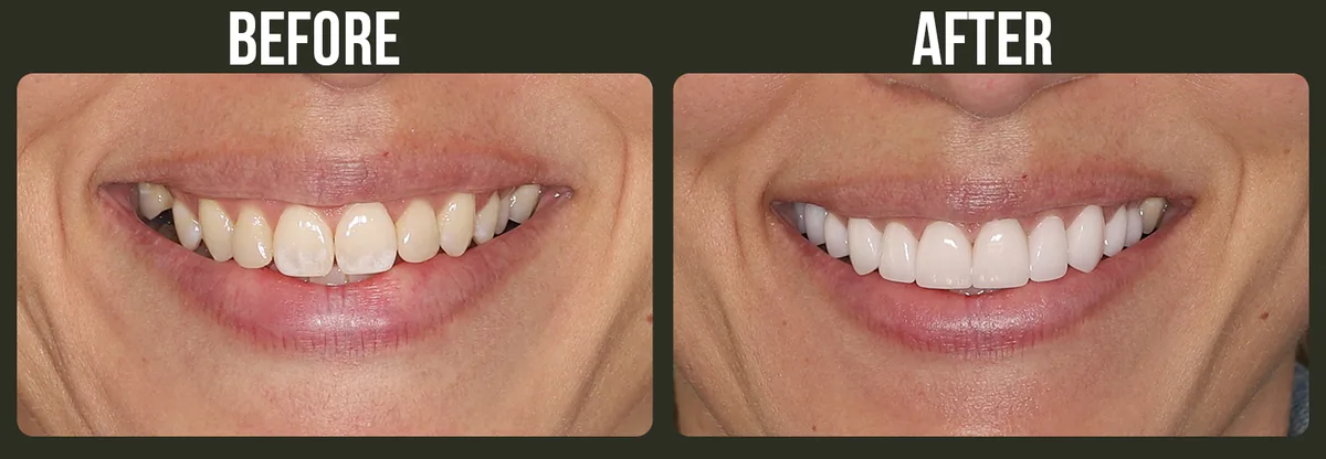 Before and after dental treatment — Horizon Dental patient