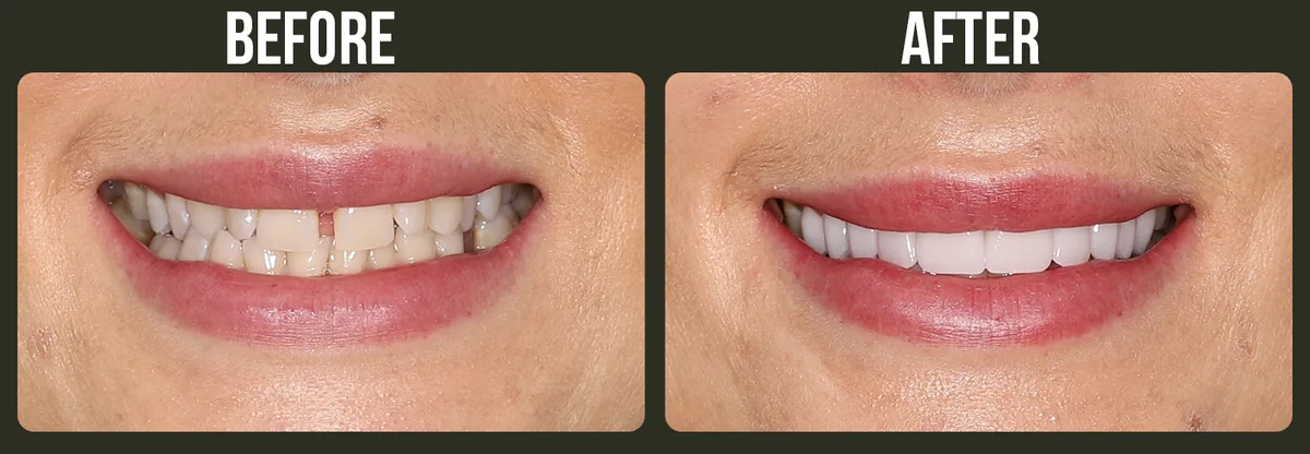 Before and after dental veneers — Horizon Dental patient